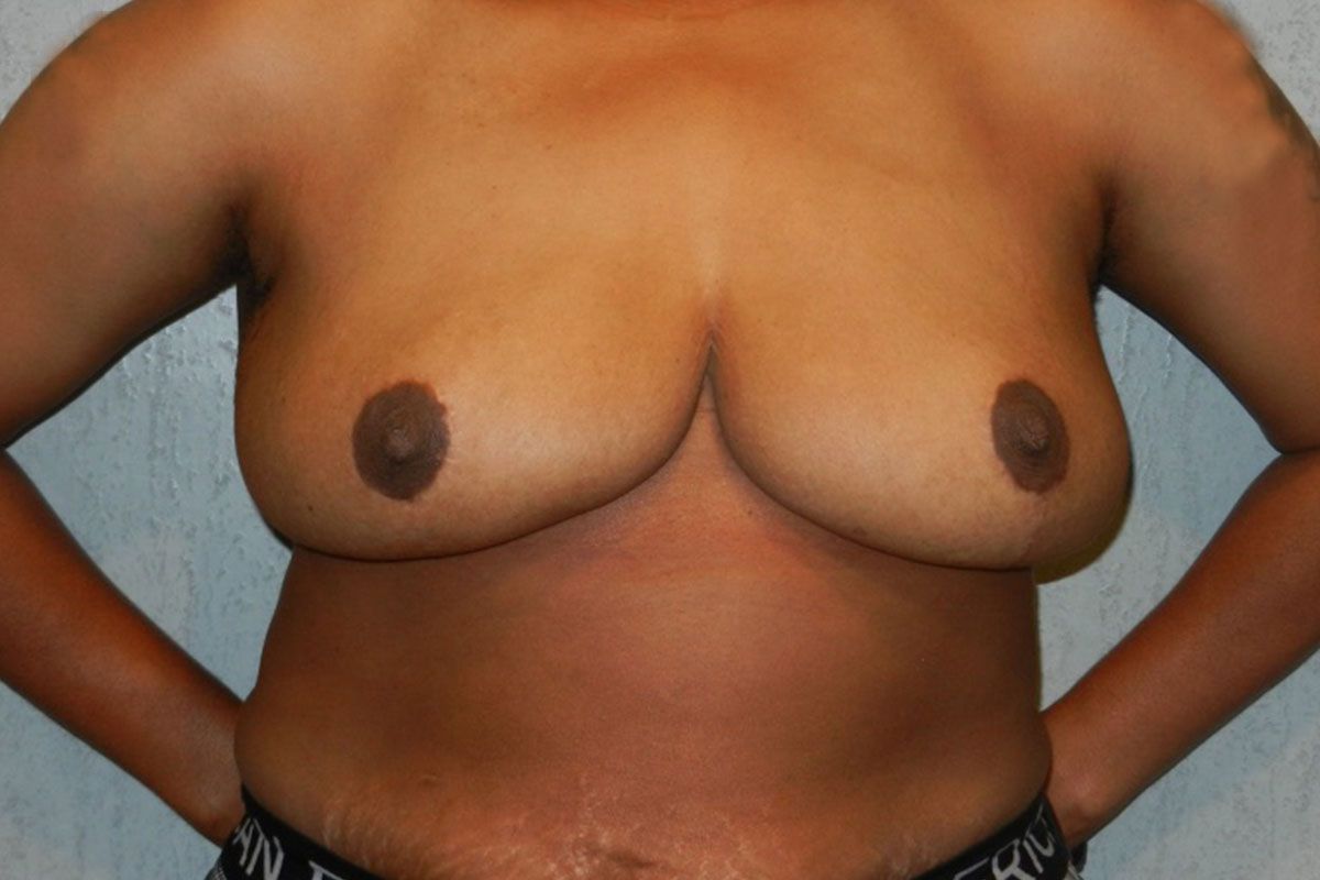 Breast Procedure Gallery #12 After – North Charleston, SC – Palmetto Plastic Surgery