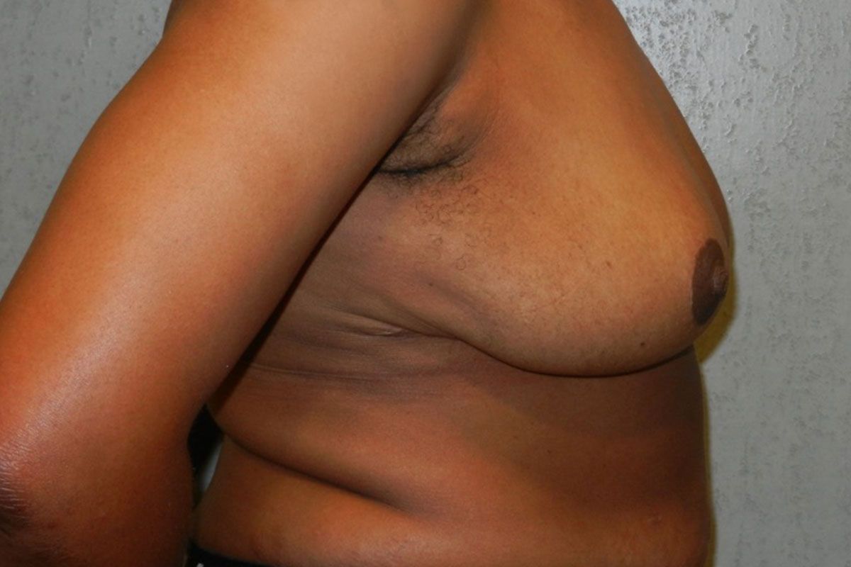 Breast Procedure Gallery #13 After – North Charleston, SC – Palmetto Plastic Surgery