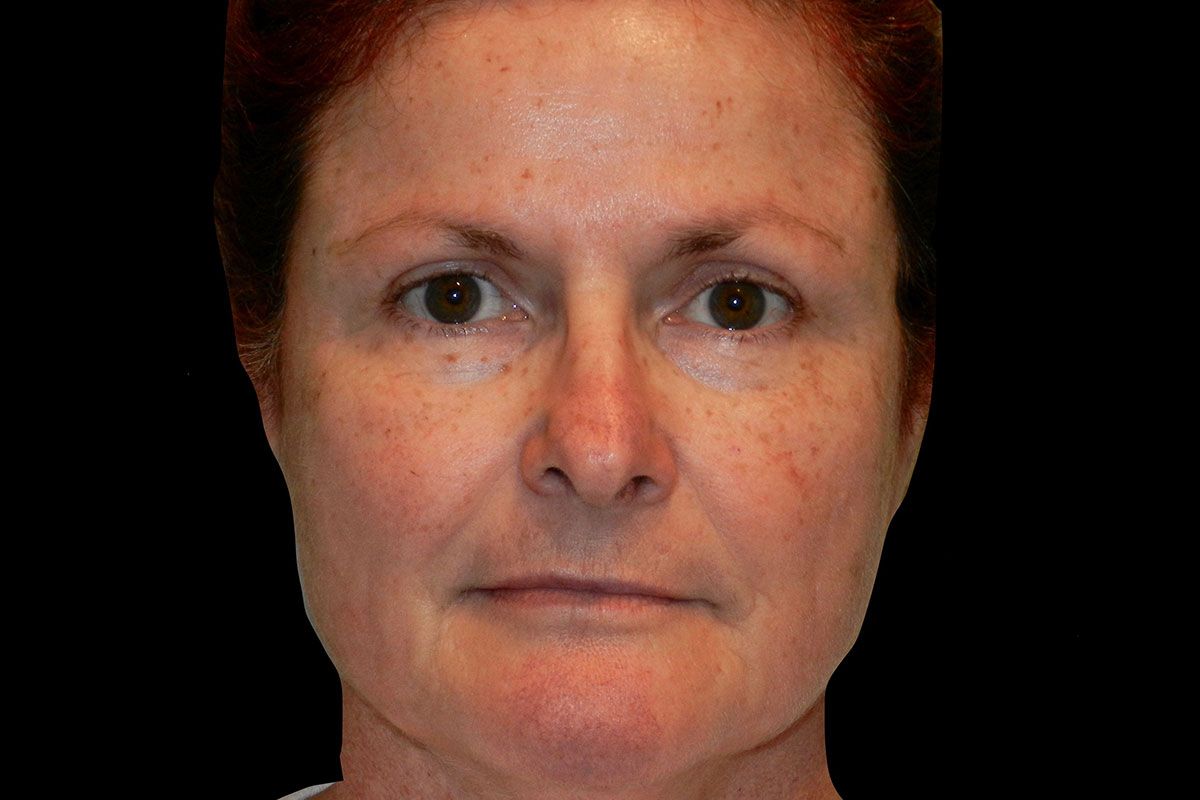 Facial Procedure Gallery #12 After – North Charleston, SC – Palmetto Plastic Surgery