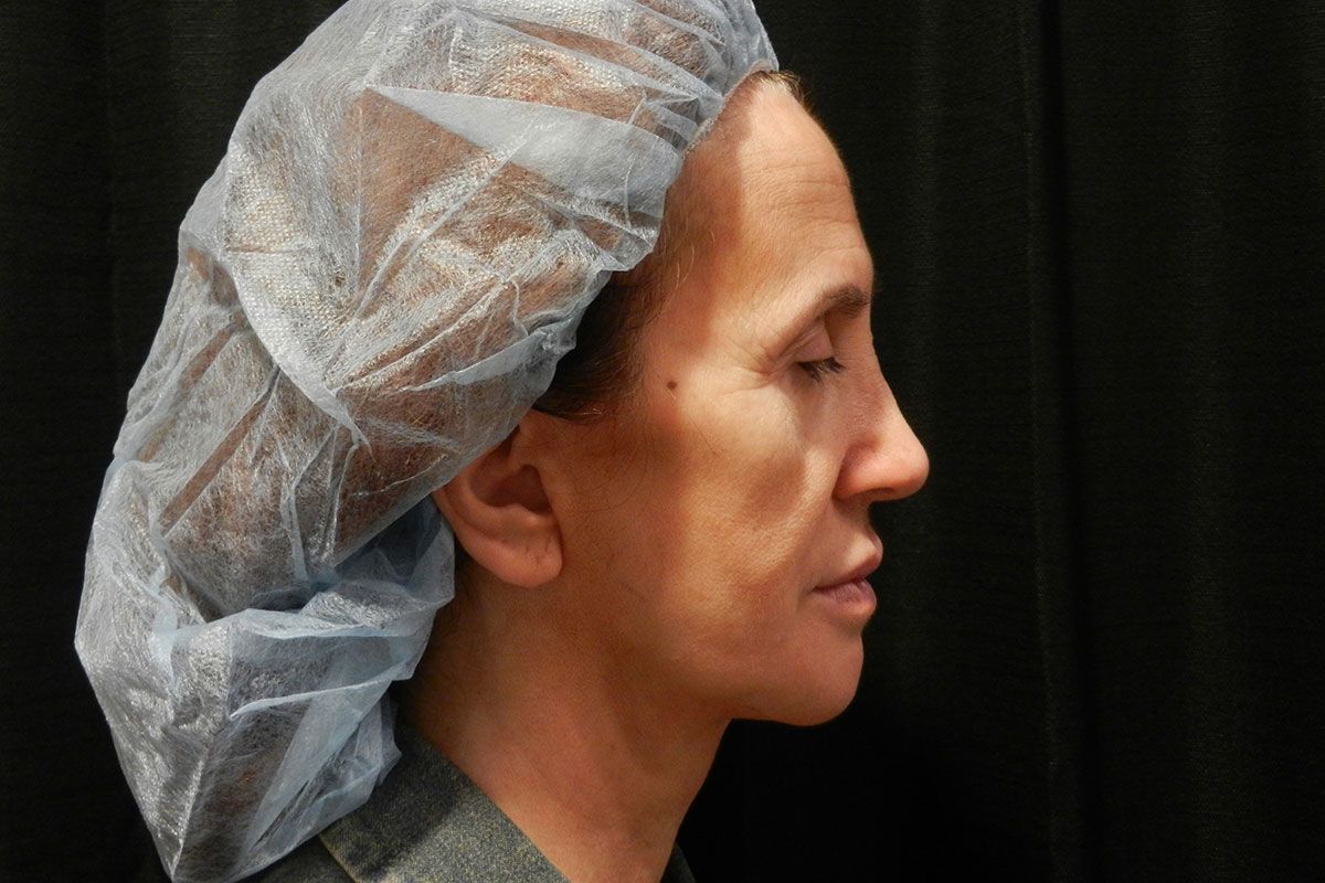 Facial Procedure Gallery #11 Before – North Charleston, SC – Palmetto Plastic Surgery