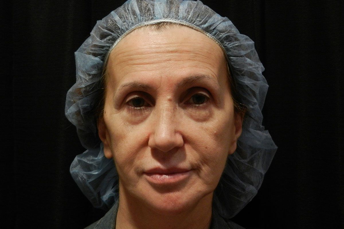 Facial Procedure Gallery #9 Before – North Charleston, SC – Palmetto Plastic Surgery