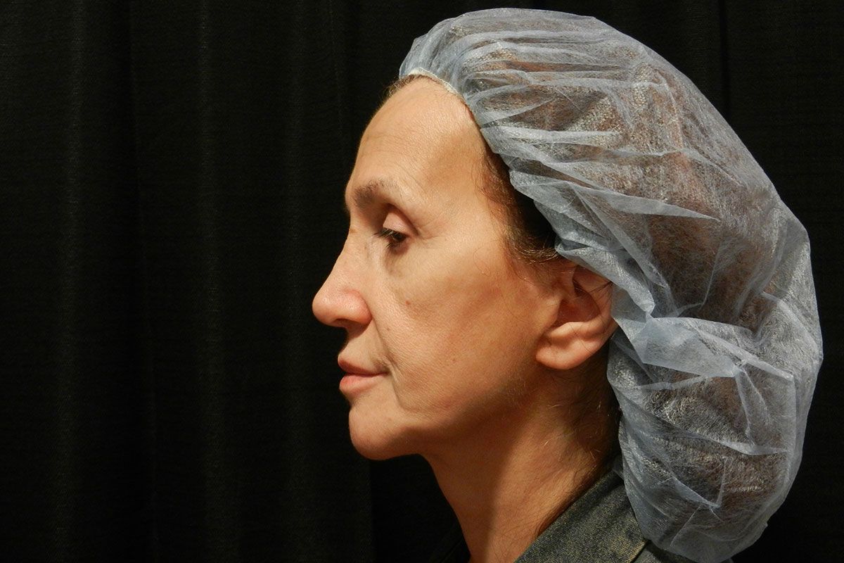 Facial Procedure Gallery #10 Before – North Charleston, SC – Palmetto Plastic Surgery