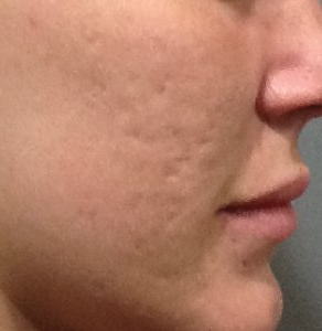 After two treatments with laser hair removal cynosure