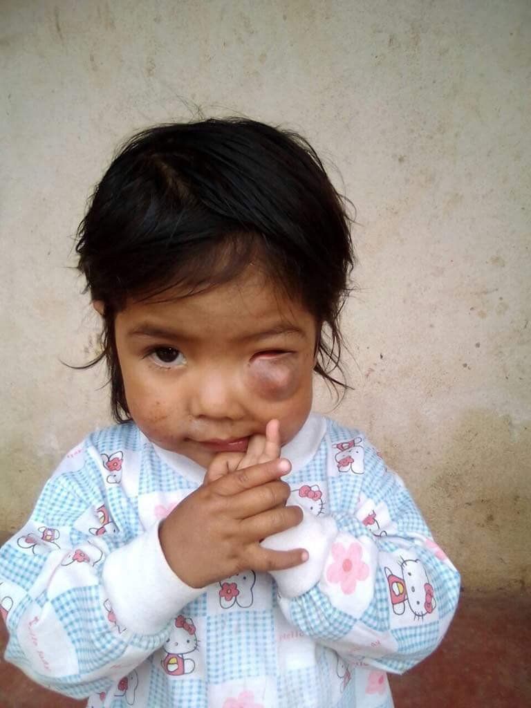 Kind mit geschwollenem Auge, das sich die Hand ans Gesicht hält, trägt ein gemustertes Hemd und steht in der Nähe einer Wand.