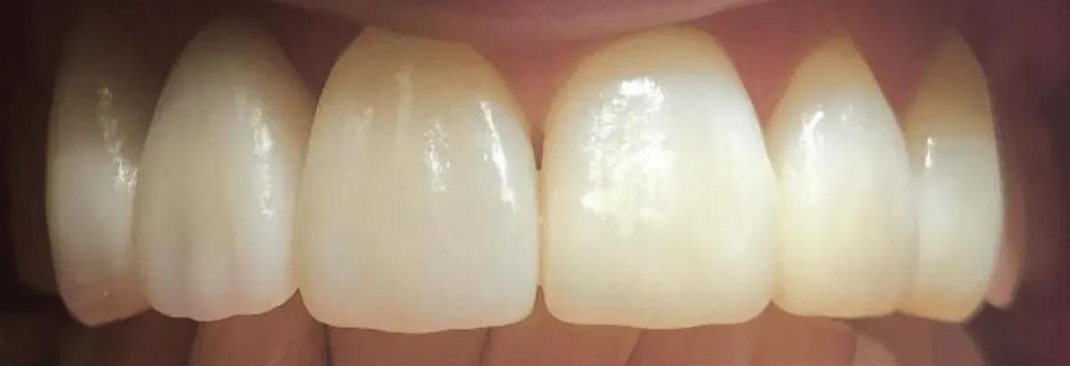 A close-up view of a person's upper and lower teeth, showing healthy gums and a slight yellow discoloration on one front tooth.