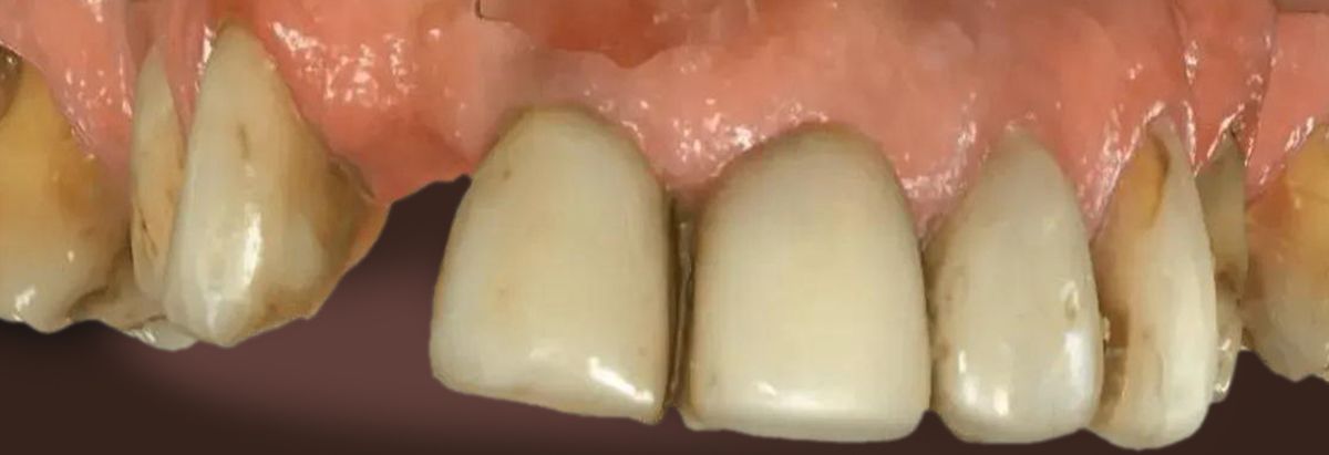 A close-up view of a person's mouth showing top and bottom teeth, with a visible gap between the lower front teeth.