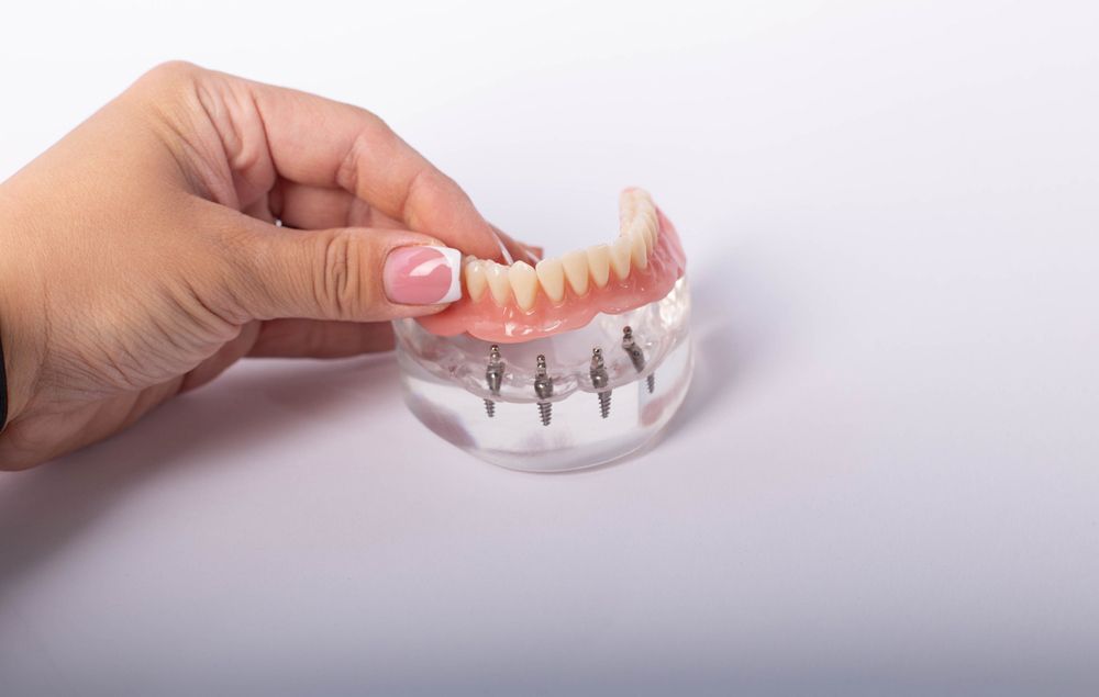 A Woman is Holding a Model of a Denture With Dental Implants — Ballina Denture Clinic Michael J Parker in Ballina, NSW