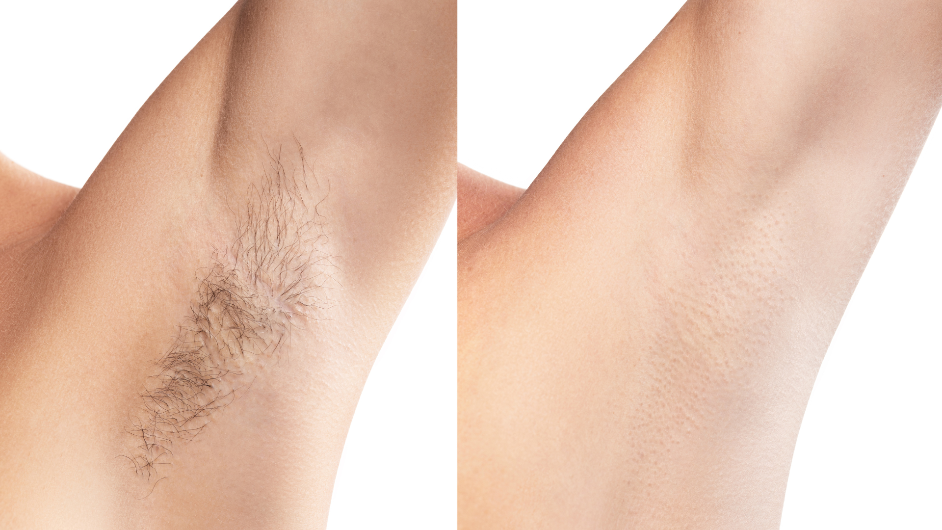 A before and after photo of a woman 's underarm.