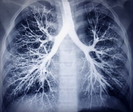 Médico Internista Laura Vicente - Agua en los pulmones