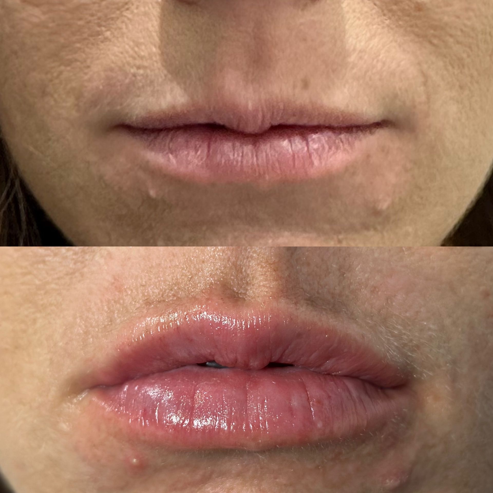 Before and after photo of Lip filler treatment