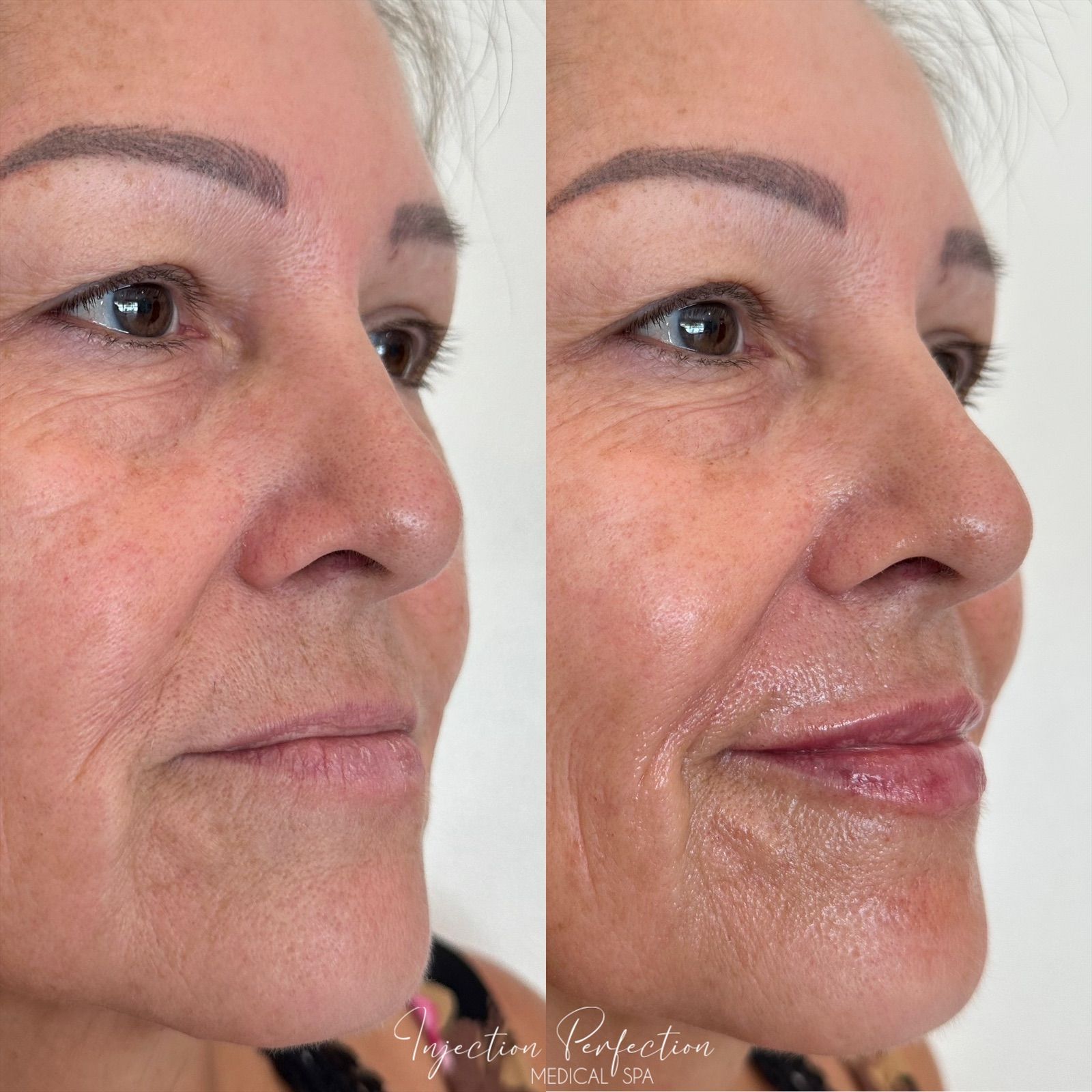 Before and after photo of lip filler treatment