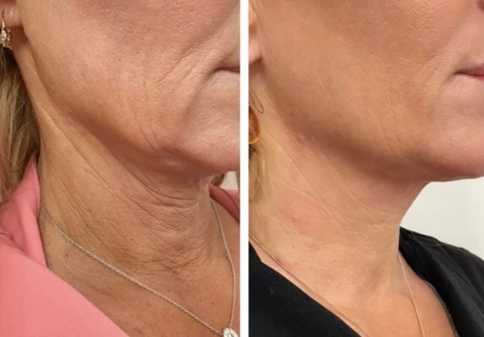 Before and after photo of Lipodissolve treatment. Neck fat loss