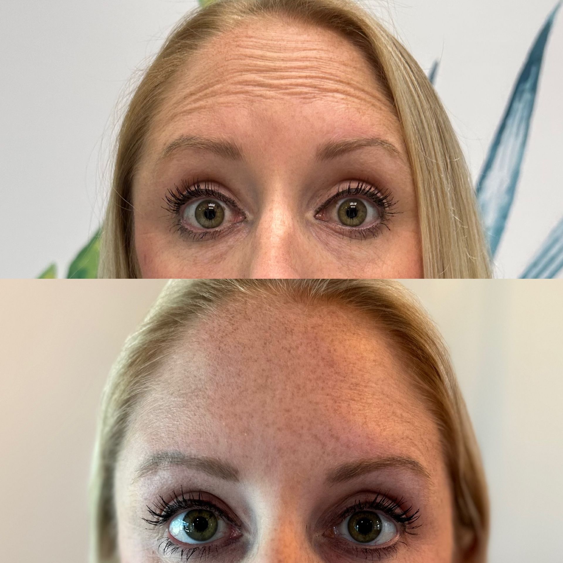 Before and after photo of forehead botox treatment