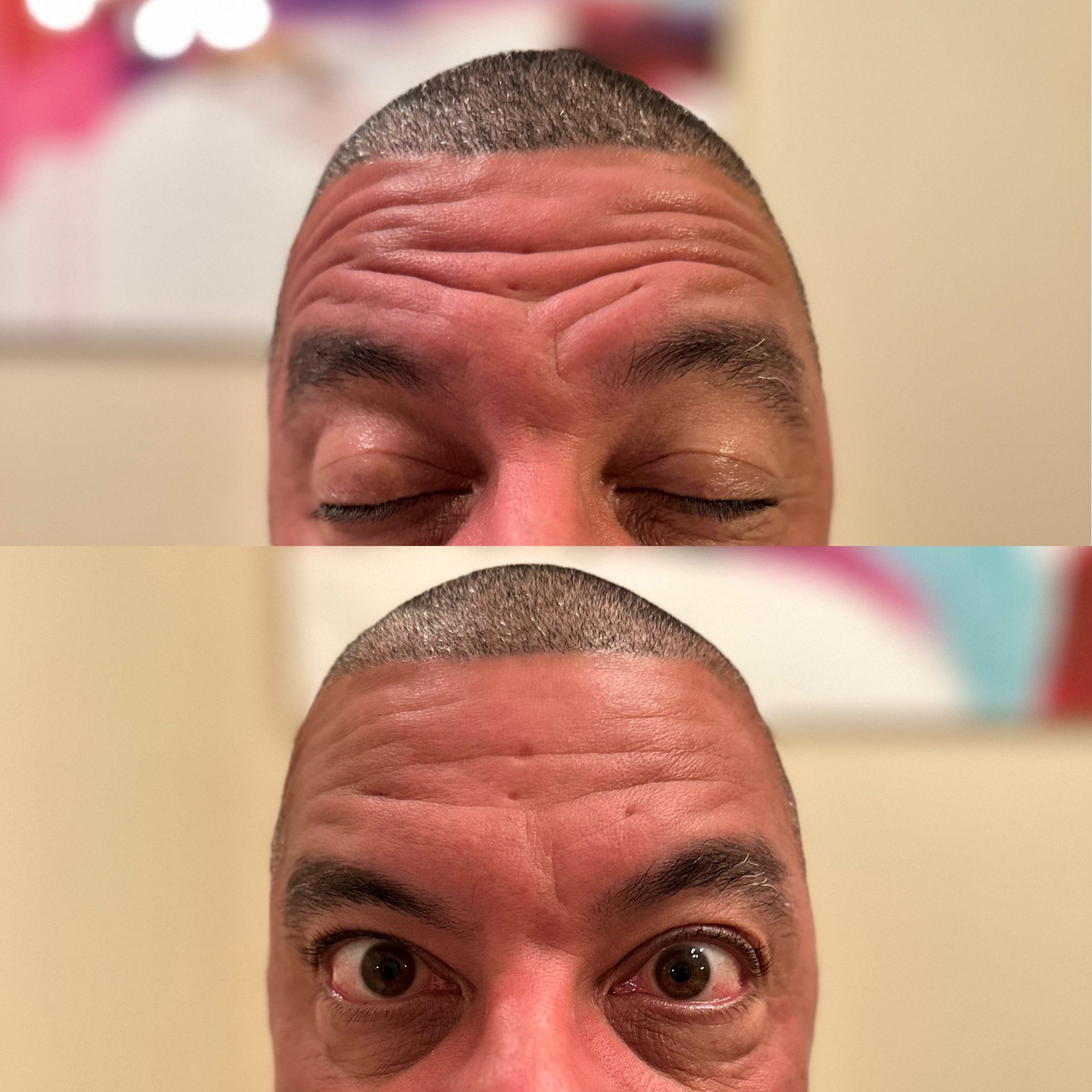 Bro Tox. Before and after photo of man's forehead