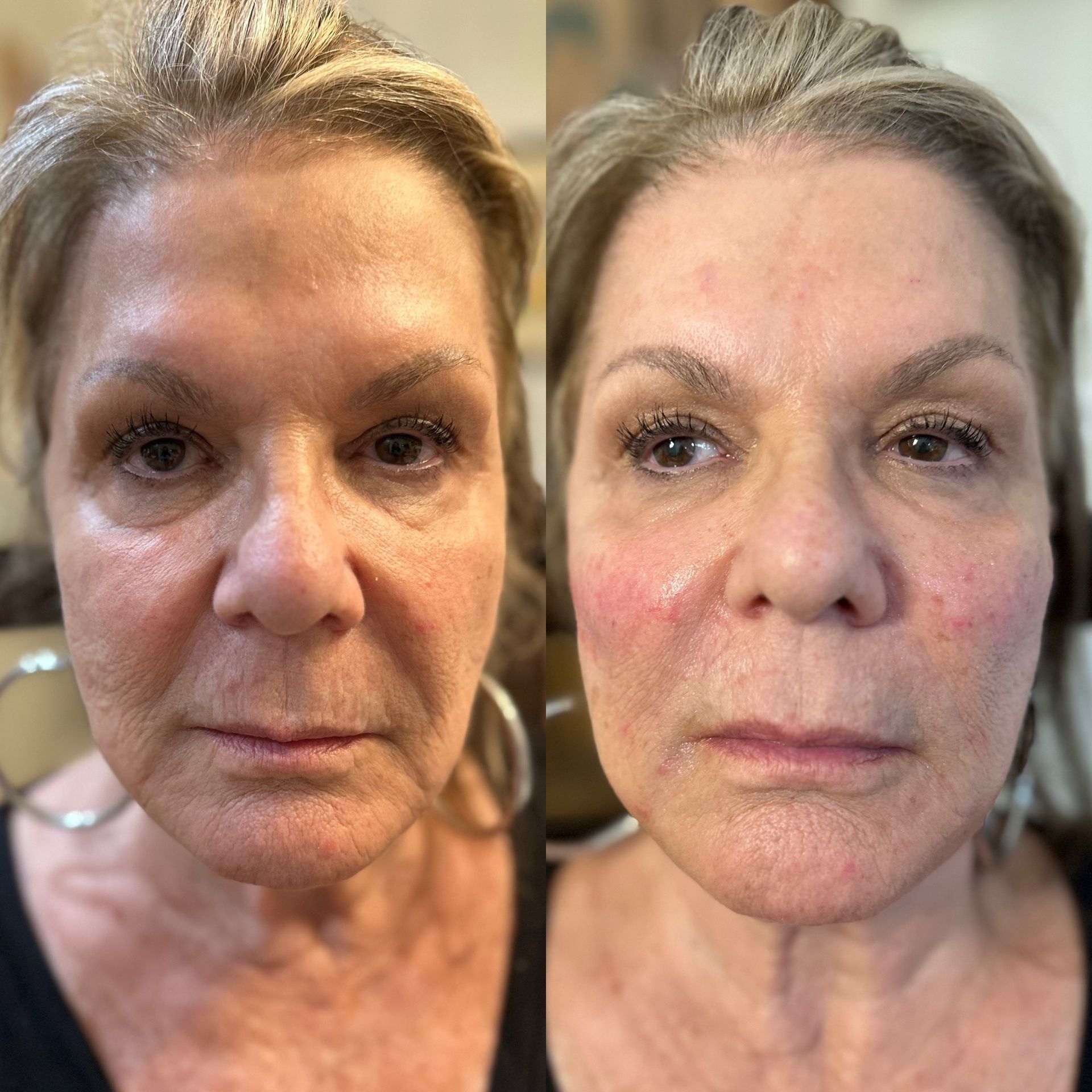 Facial Balancing in Boca Raton