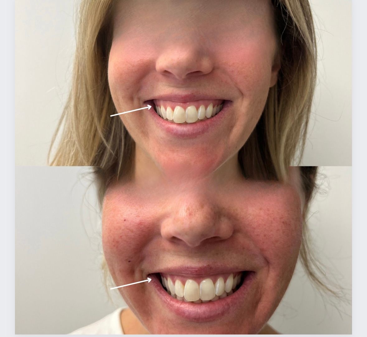 Before and after photo of Gummy Smile Botox treatment