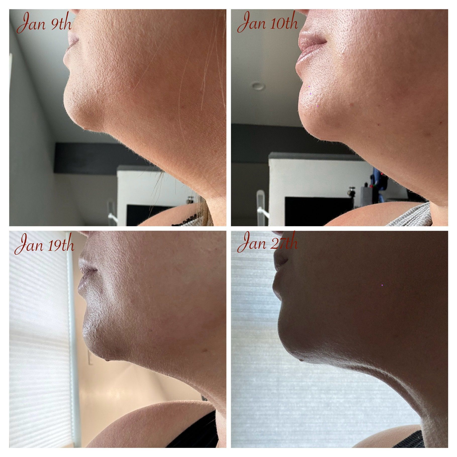 Lipodissolve treatment before and after results. Neck fat loss