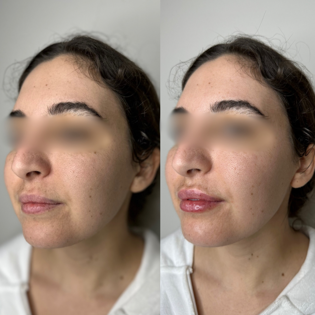 Lip Filler treatment before and after results