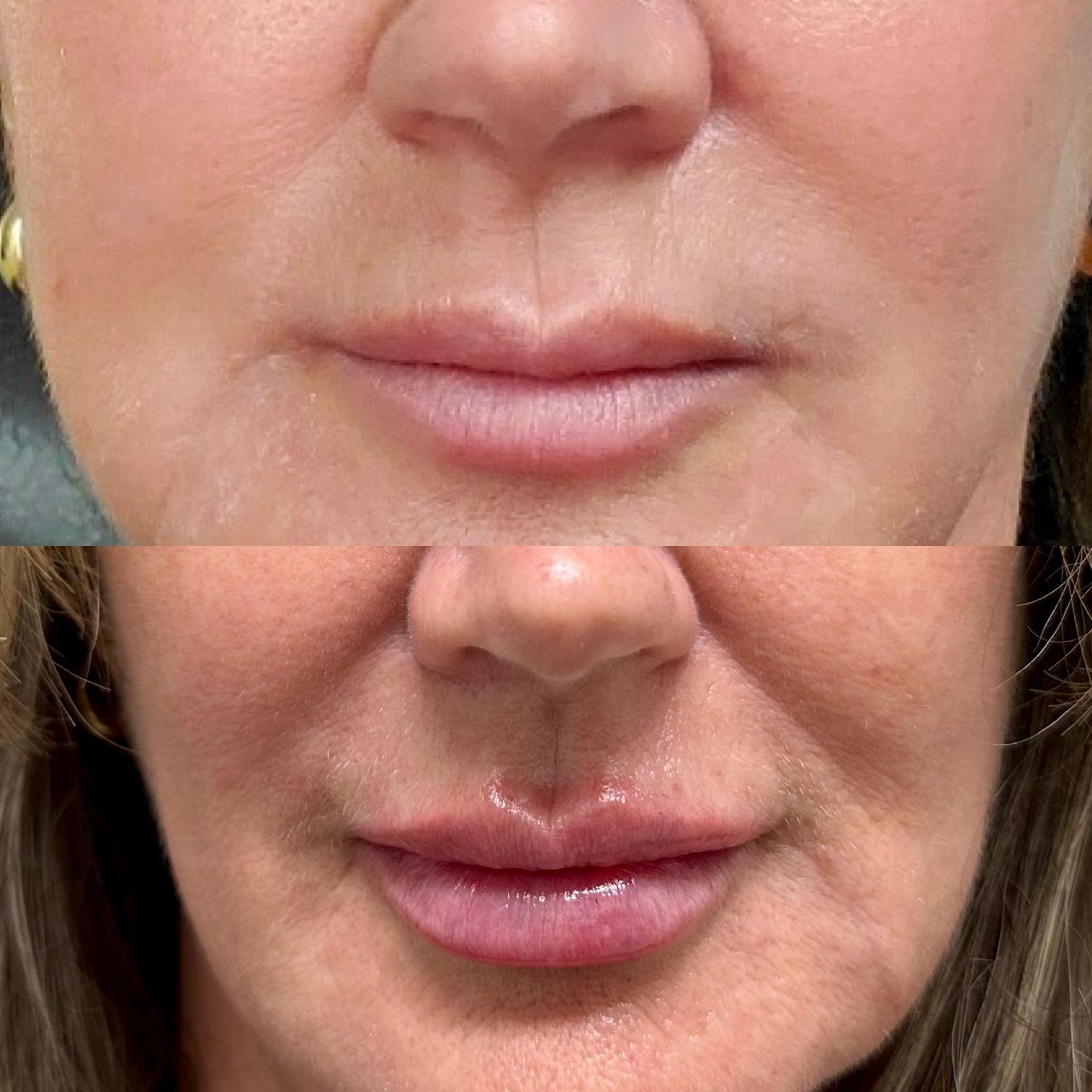 Before and after photo of mini lip plump treatment