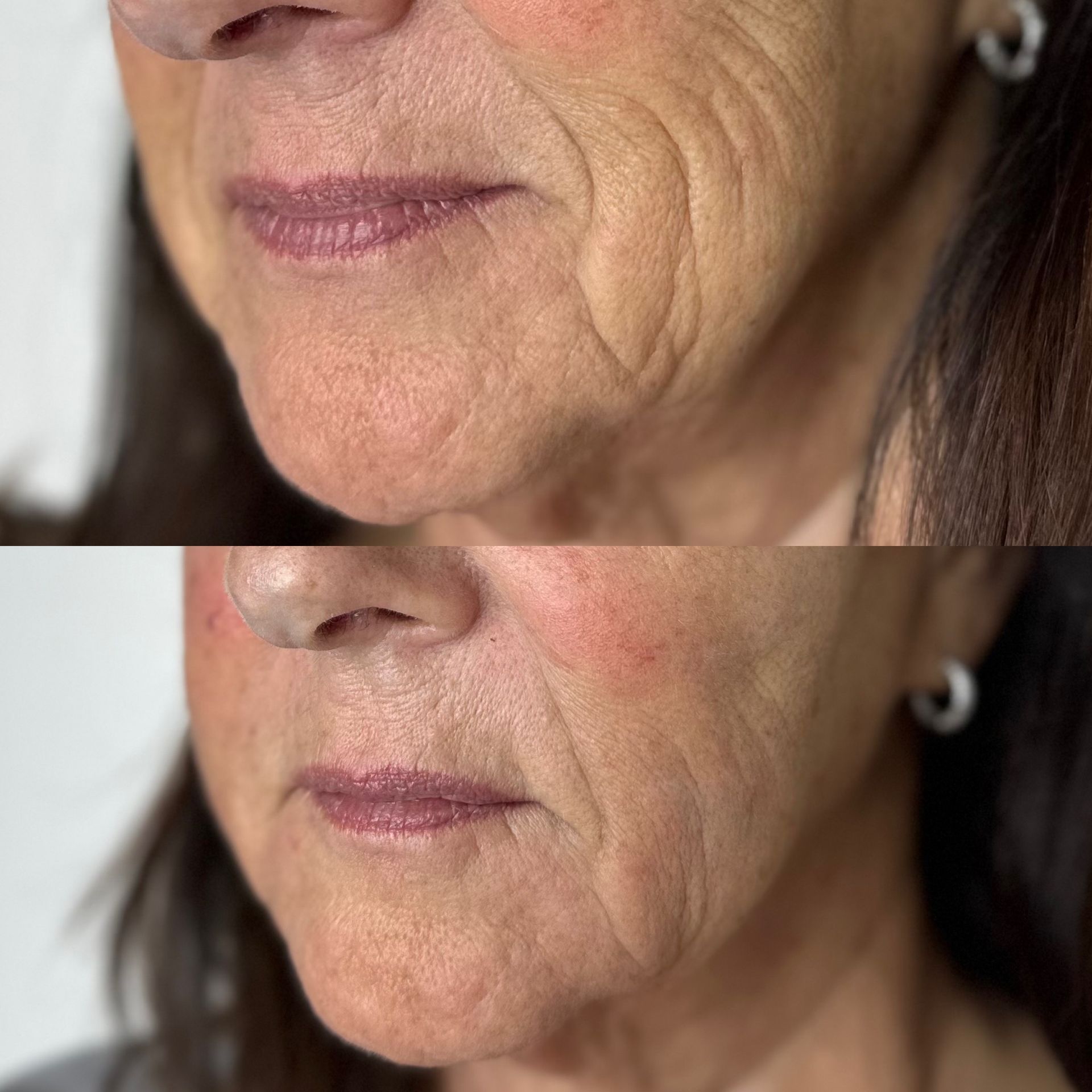 Marionette Lines filler treatment before and after results
