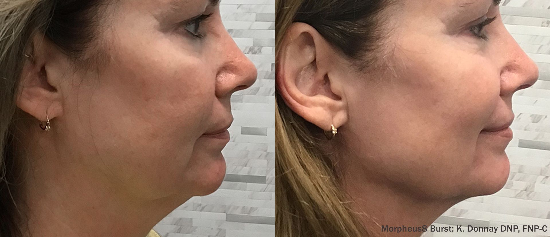 Morpheus8 treatment in Boca Raton