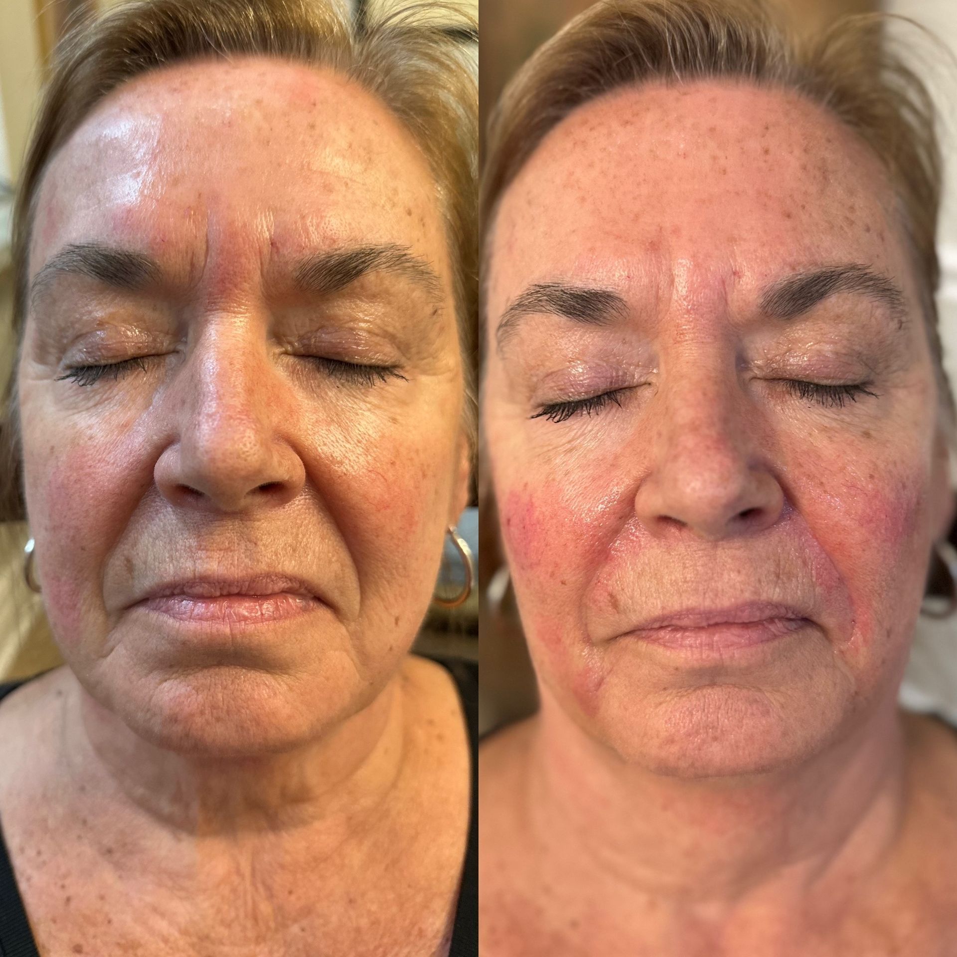 Nasolabial folds filler treatment before and after results