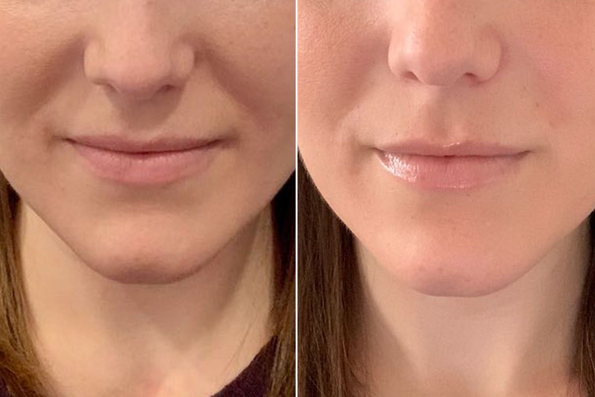 Before and after photo of Nasolabial folds filler treatment