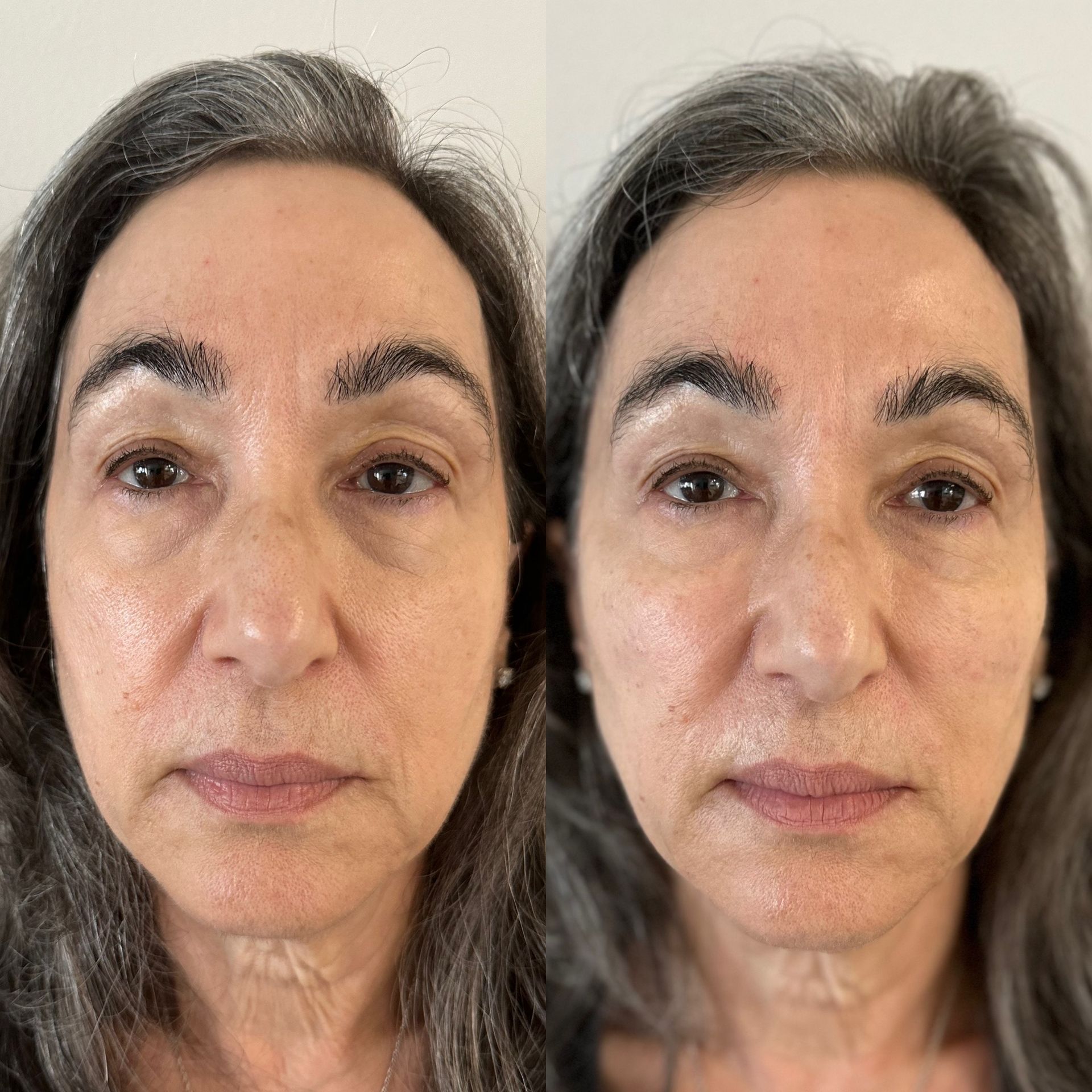 Sculptra treatment before and after results