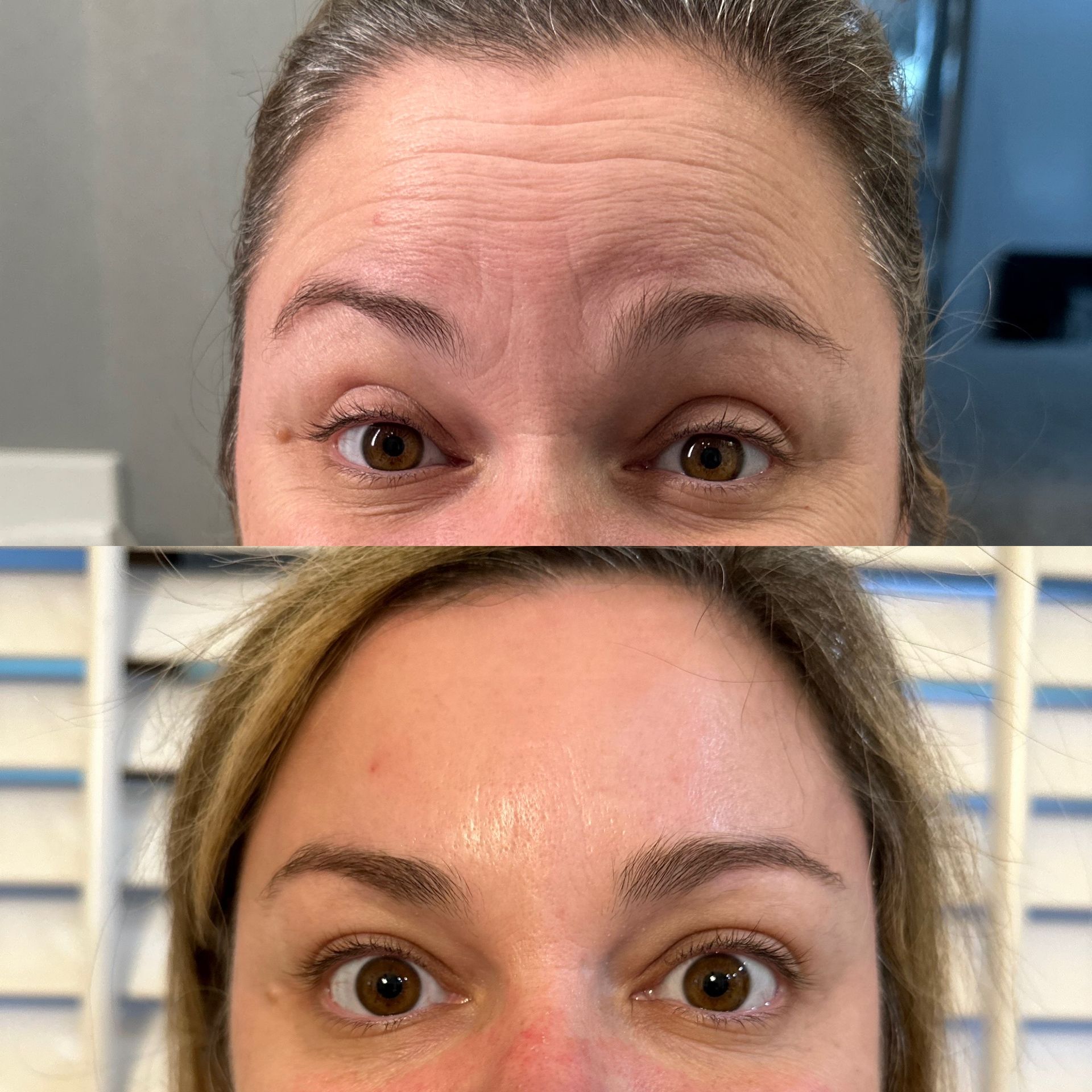 Forehead Botox treatment before and after result