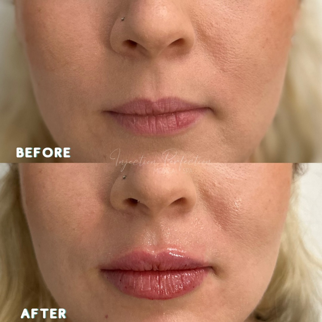 Lip filler before & after