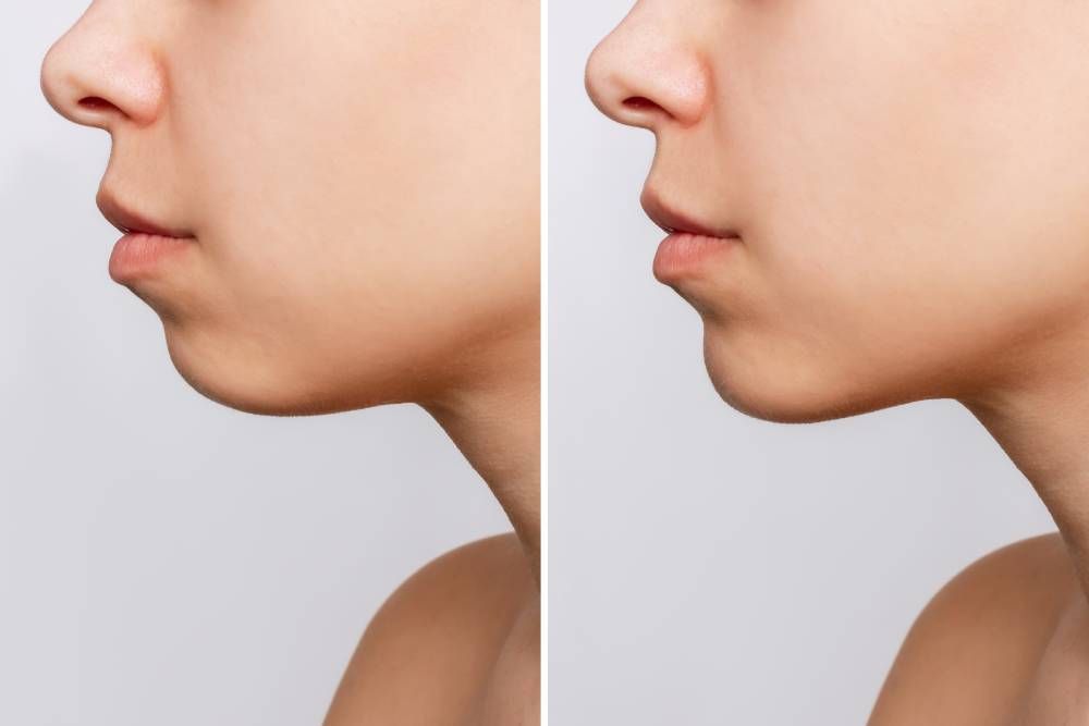 Before and after photo of Chin augmentation filler treatment