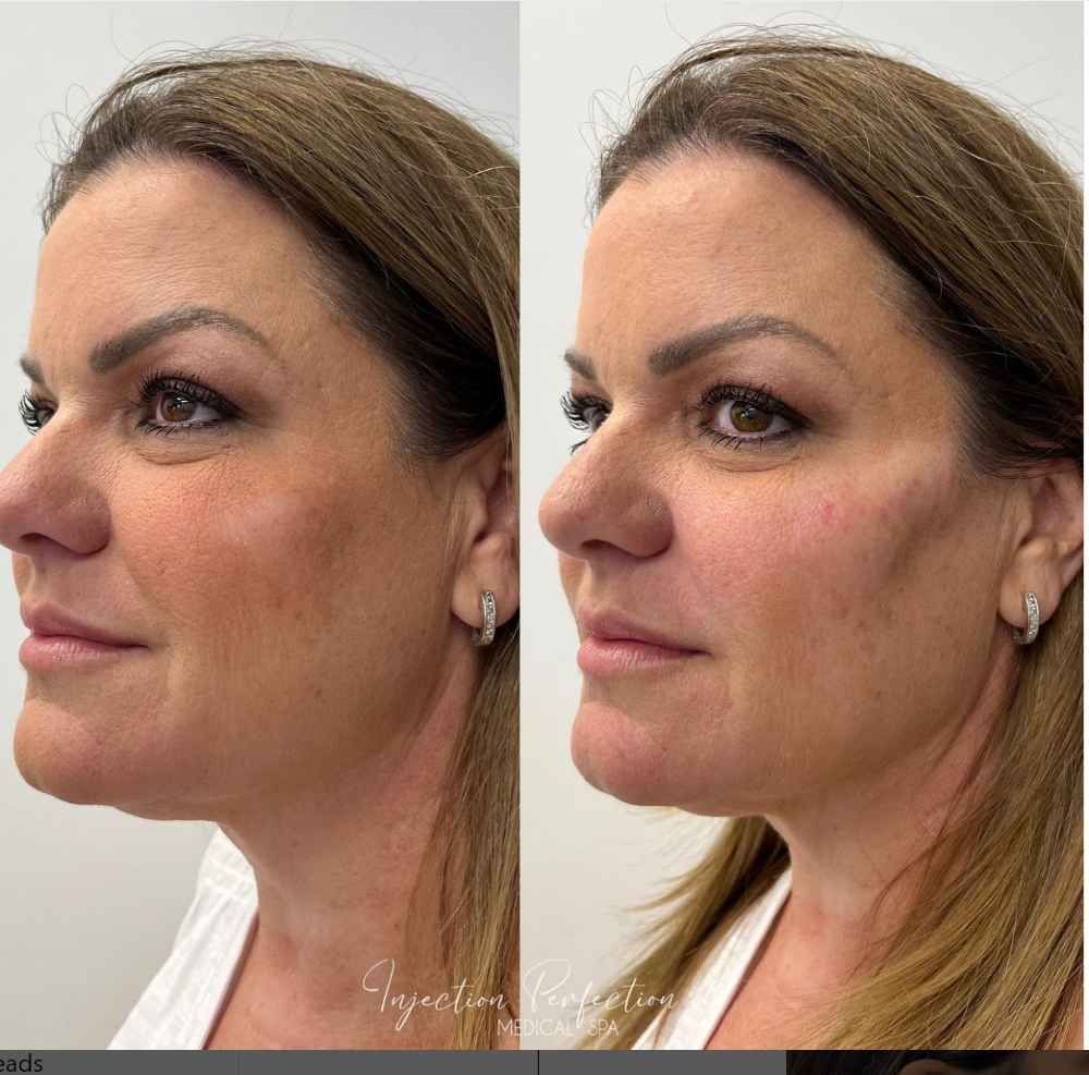 Before and after photo of Midface (cheeks) filler treatment