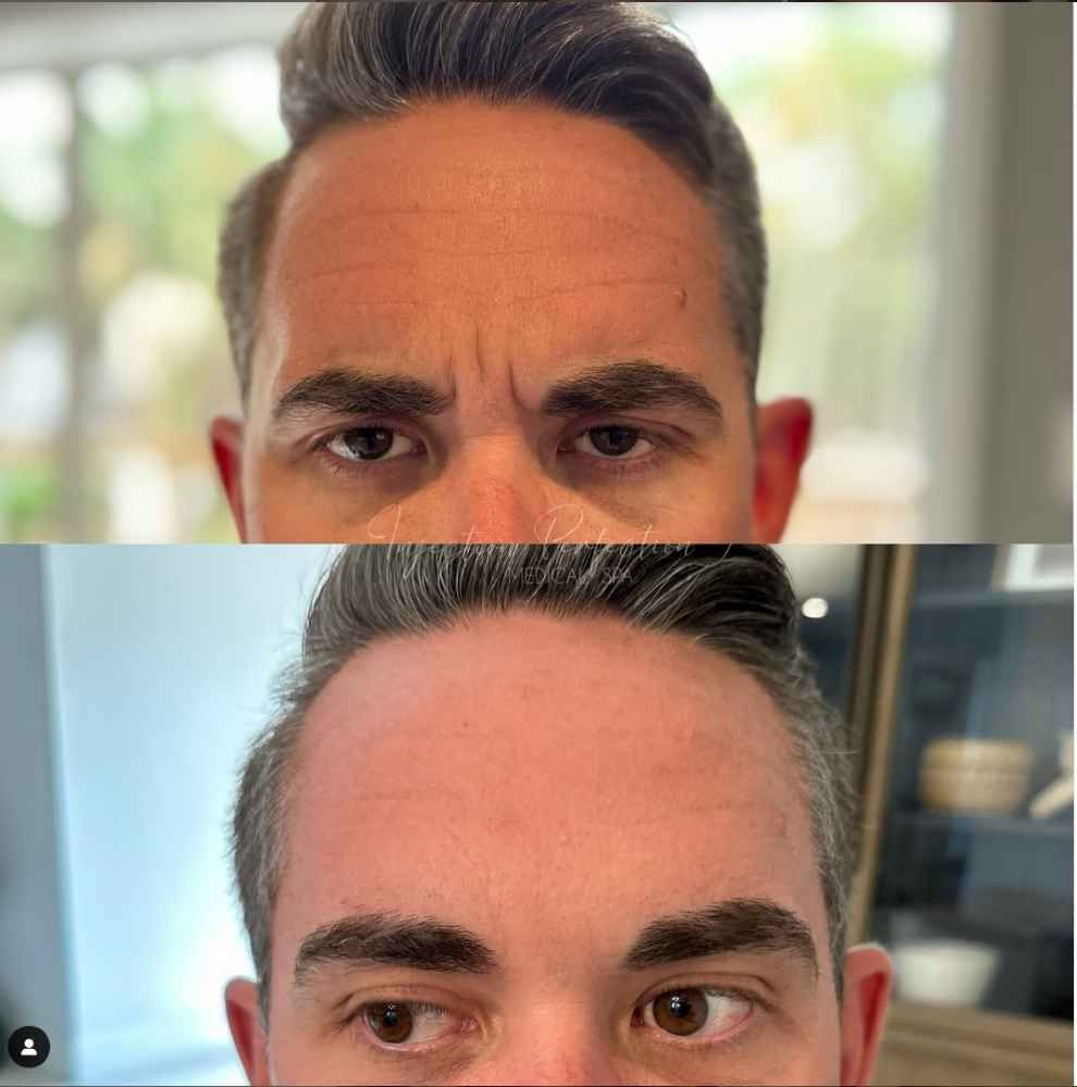 Before and after of 11's Botox Treatment