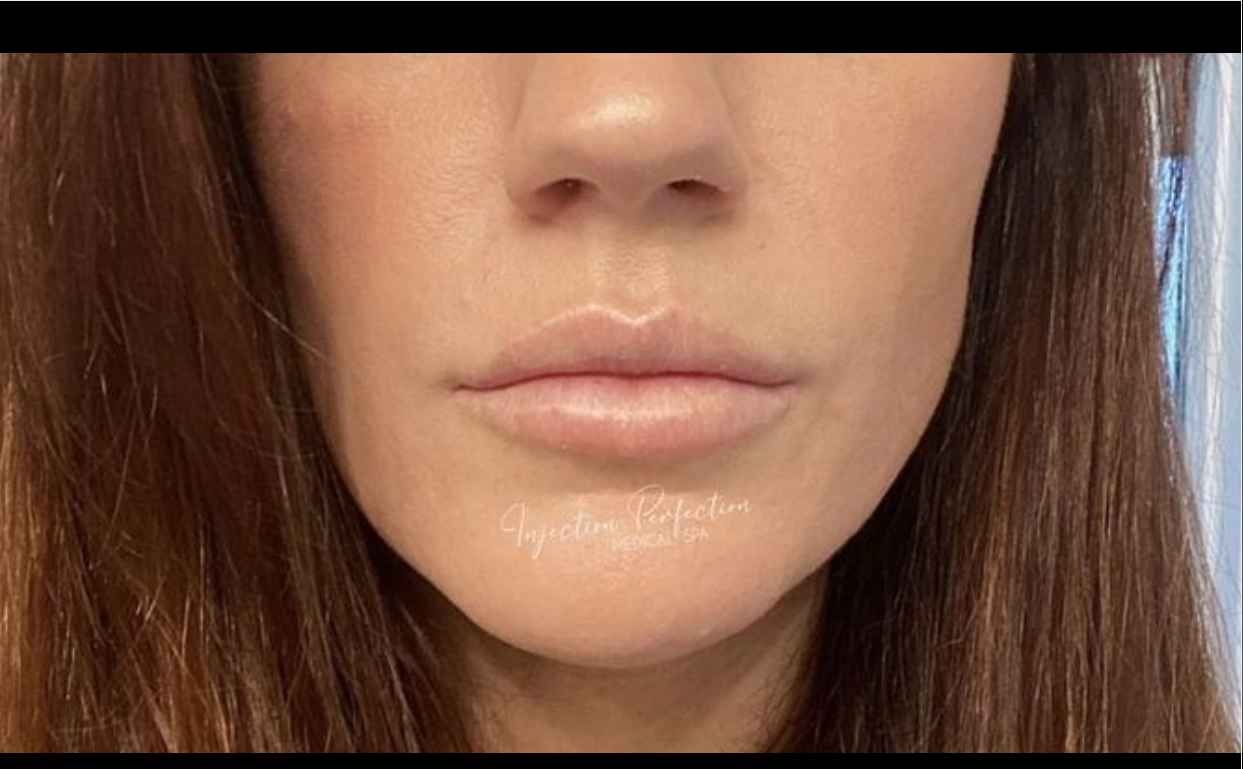 lip filler results