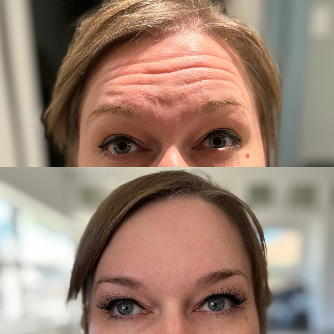 forehead Botox before & after