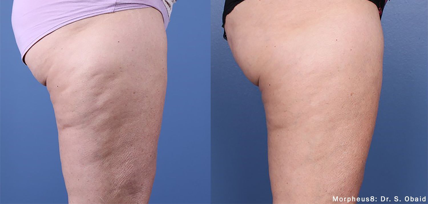 Morpheus8 Skin Tightening before and after for body