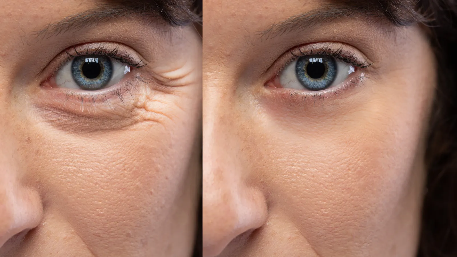Botox for Crow's Feet in Boca Raton