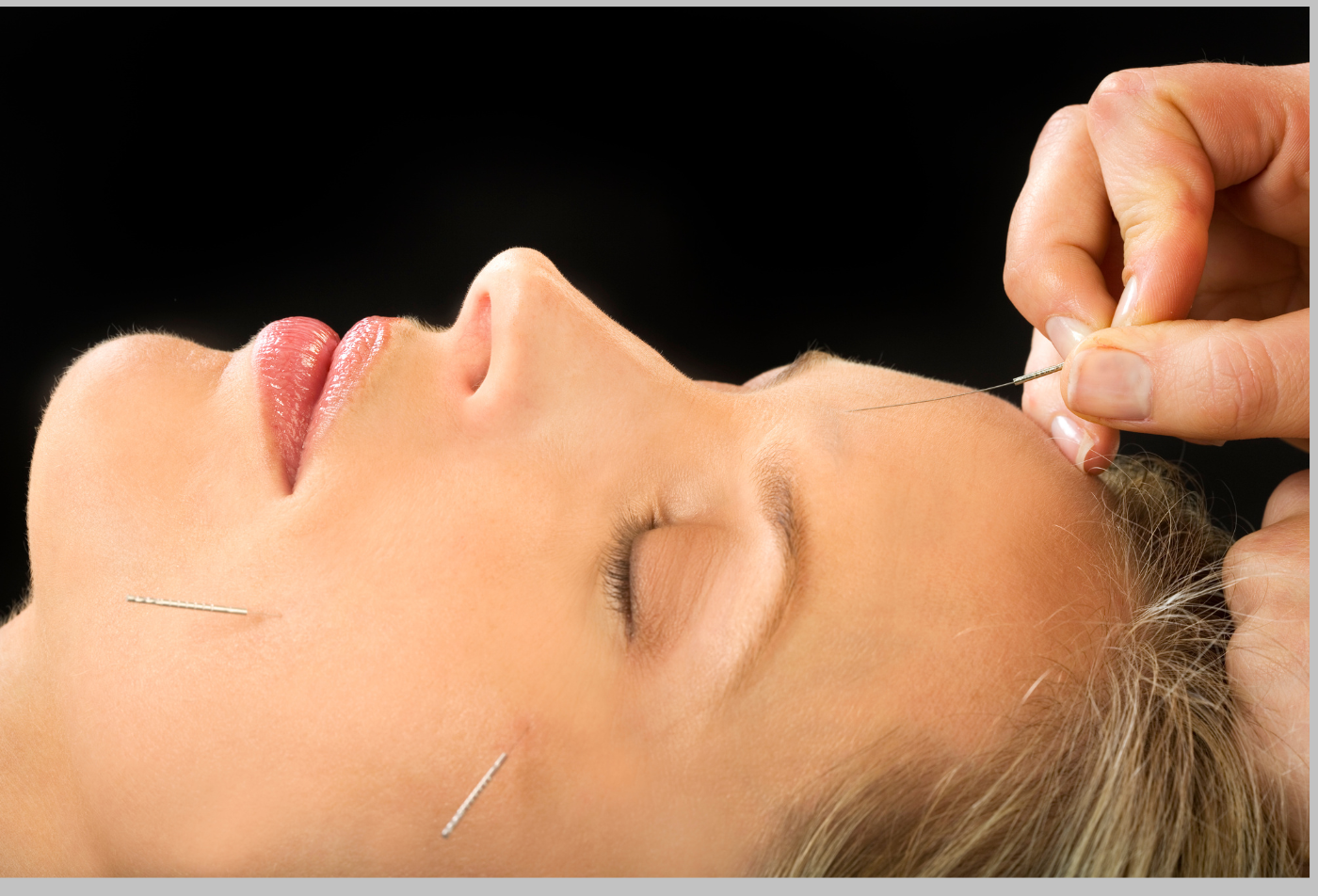 Anti-Aging Acupuncture Facial Rejuvenation Services in St. Petersburg Florida. Call Today to Book an Appointment!