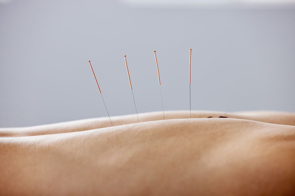 A Person is Getting Dry Needle on Their Back — Sugarland Chiropractic Centre in Avoca, QLD