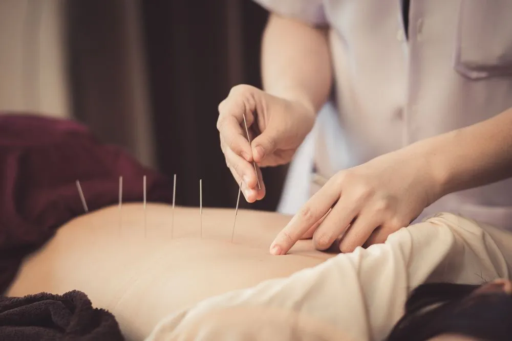 A Person is Getting Dry Needle Treatment on Their Back — Sugarland Chiropractic Centre in Avoca, QLD