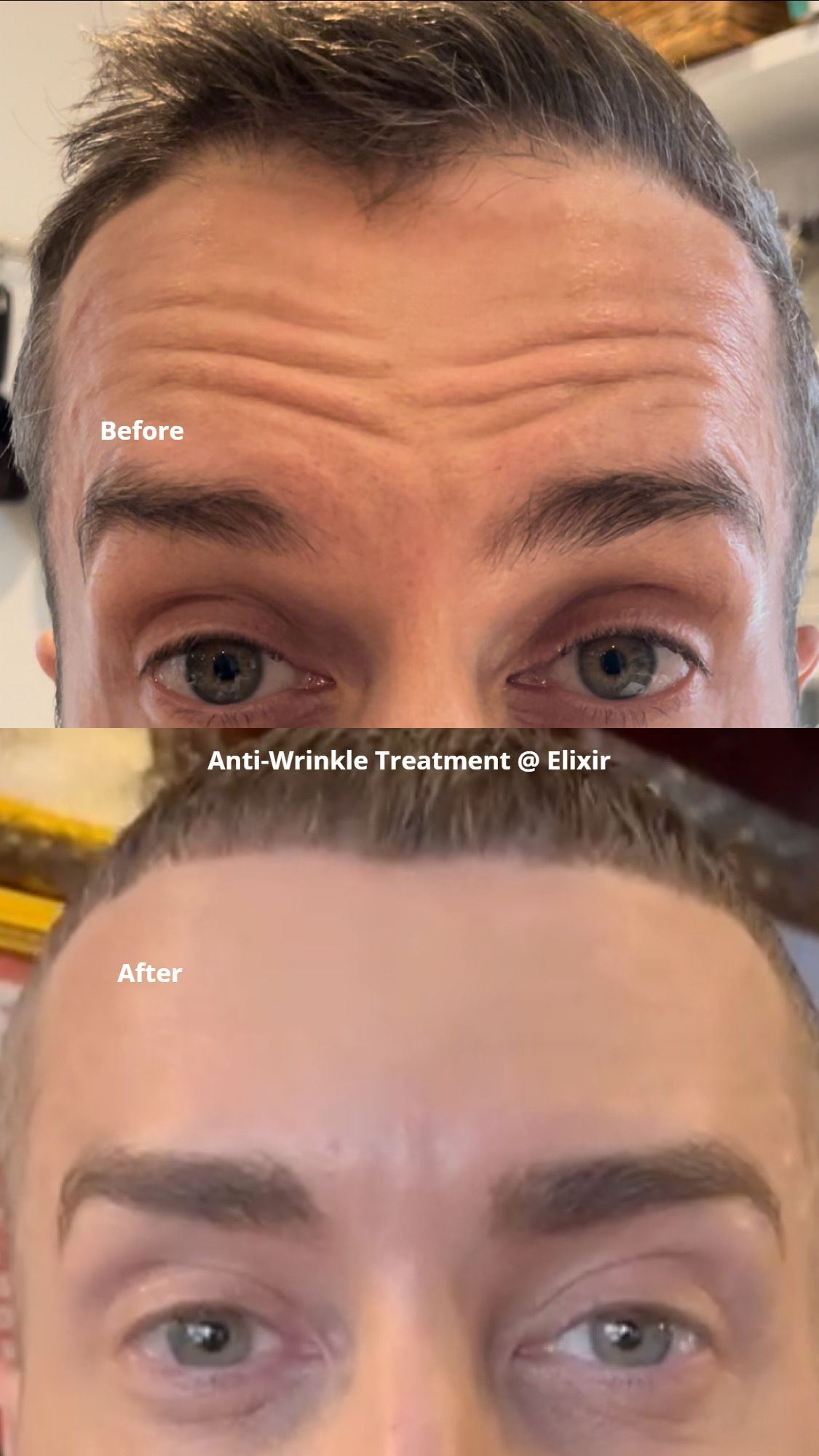 anti-wrinkle treatment to reduce wrinkles and fine lines