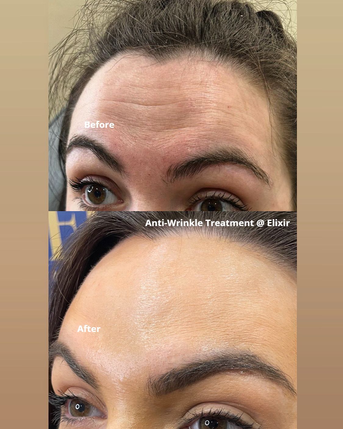 anti-wrinkle treatment to reduce wrinkles and fine lines