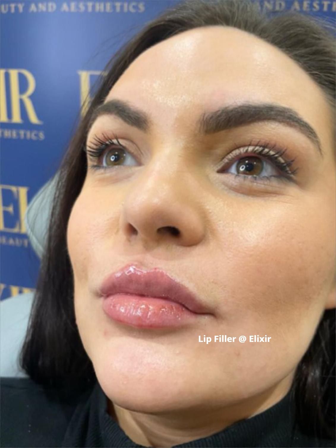 Lip fillers involves injecting a clear, gel-based filler into the lips to add volume and definition
