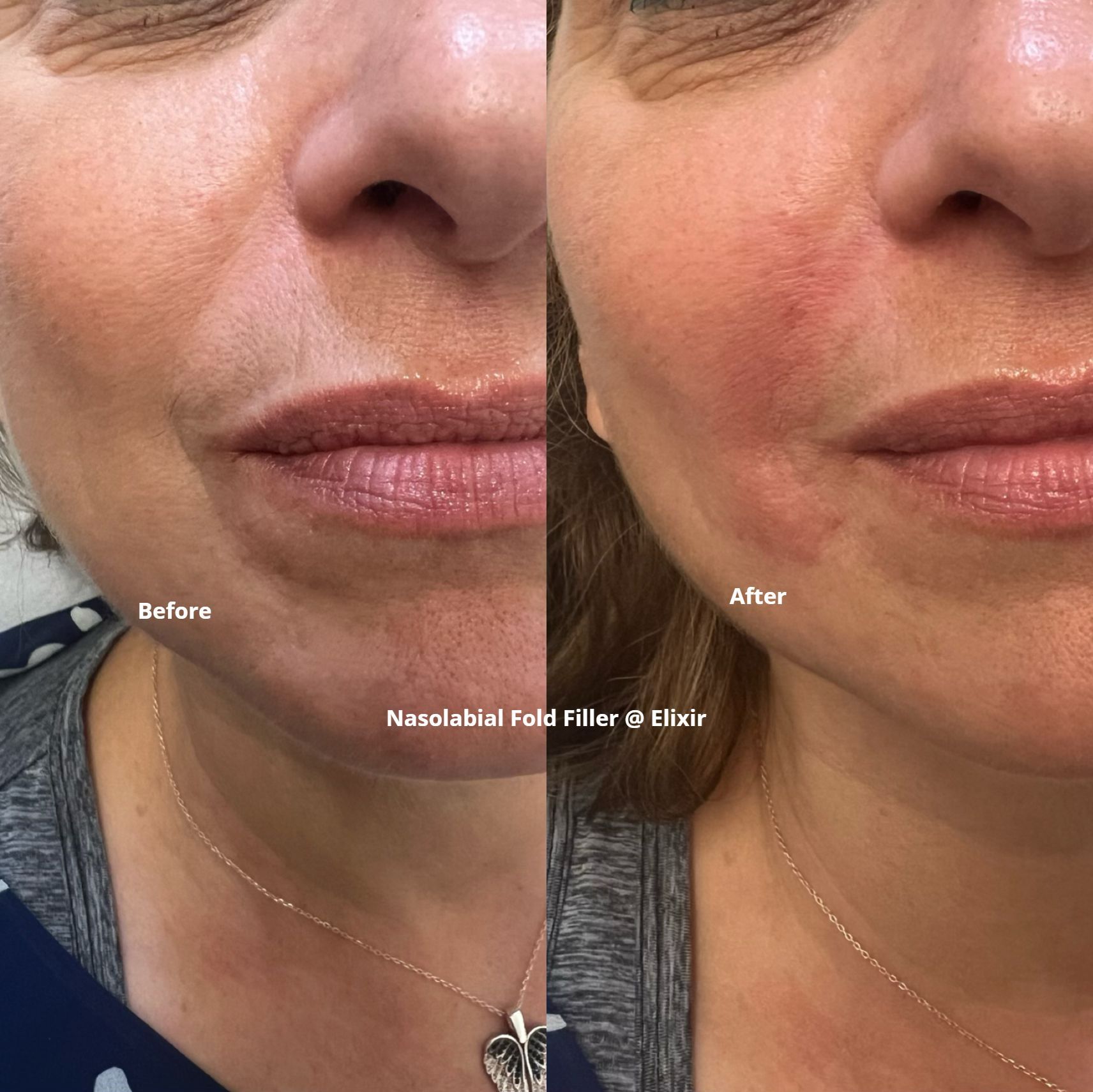 Nasolabial fold fillers reduce the appearance of the lines that run from the nose to the corners of the mouth