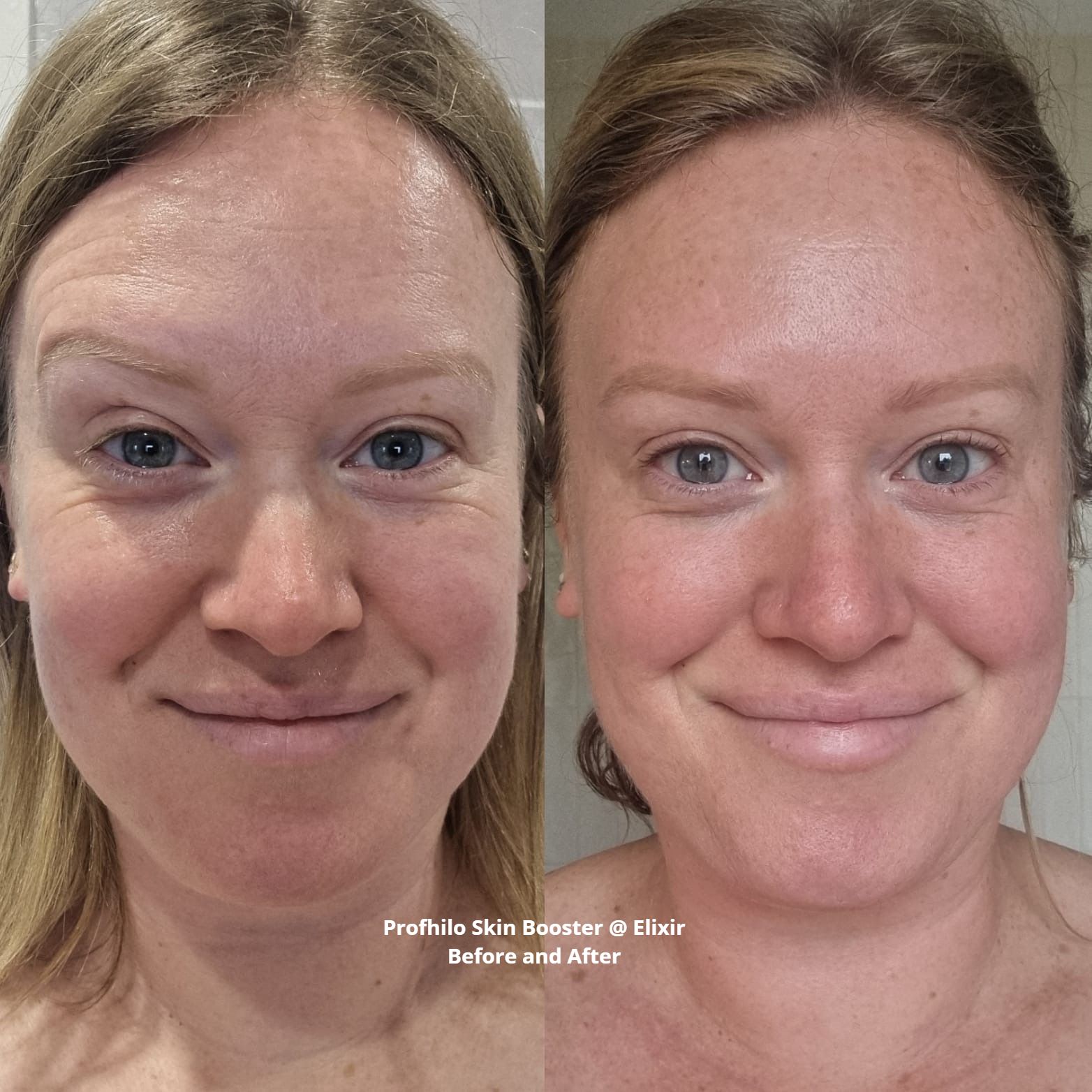 profhilo before and after. Profhilo is a skin remodeling treatment that involves  hyaluronic acid (HA) 