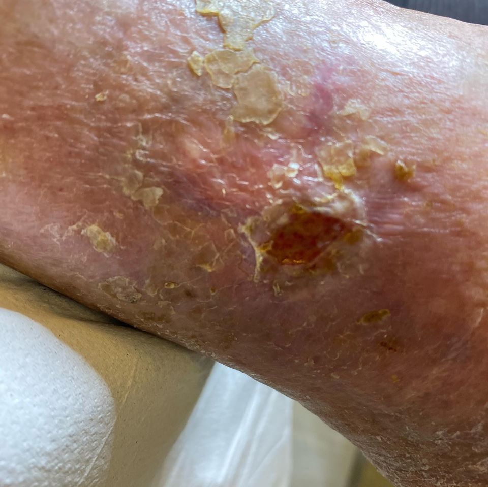 cura dei piedi nello studio podologo a Verona