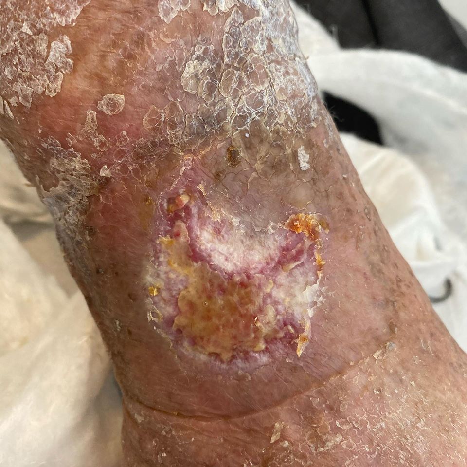 cura delle patologie dei piedi nello studio podologo a Verona e Affi