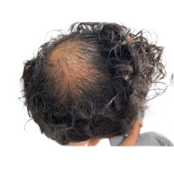 A man with curly hair has a bald spot on his head.