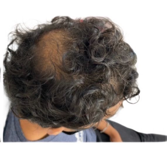 A man with curly hair has a bald spot on his head