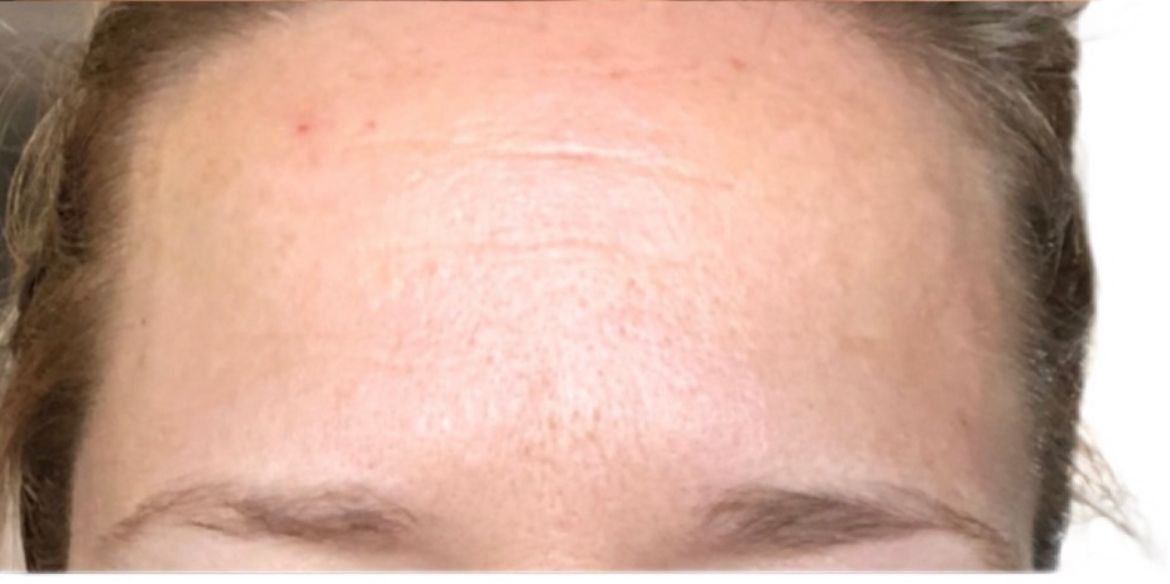 A close up of a woman 's forehead with a white background.